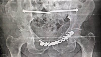 تشغيل وحدة جراحات كسور الحوض بمستشفى النيل بـ