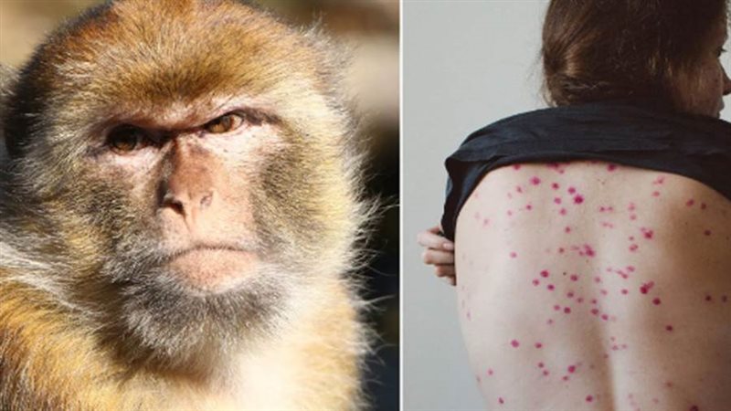 إصابتها بجدري القرود