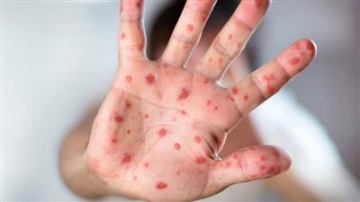 الصحة العالمية تحذر من الوضع الوبائي لفيروس جدري القرود في أفريقيا