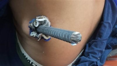 فريق طبي بمستشفى المحلة العام ينقذ حياة عامل باستخراج سيخ حديدي من جسده 