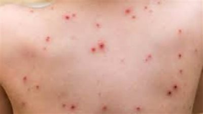 فرنسا تسجل أول إصابة بسلالة جديدة 