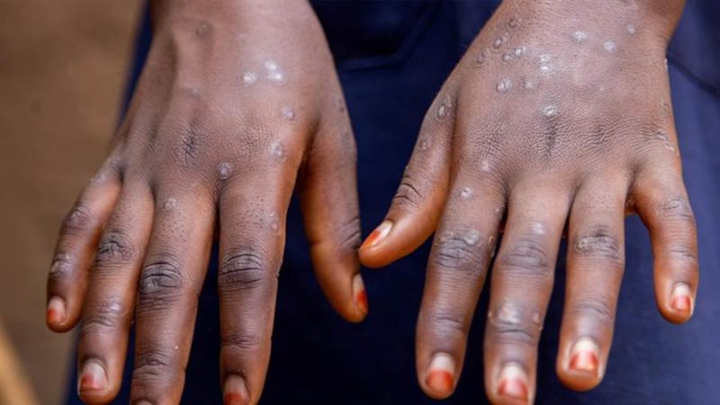 إصابة بجدري القردة