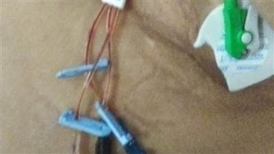 لأول مرة بمستشفى صدردمنهور.. عمل بزل طارئ لغشاء اللتامور للقلب وتركيب درنقة لحالتين من المسنين