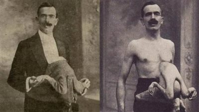 جان ليبيرا.. الرجل الذي حمل توأمه الطفيلي في رحلة عيش استثنائية!