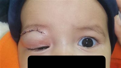 قسم طب وجراحة العيون بمستشفى سوهاج الجامعي ينجح في إنقاذ عين رضيعة تبلغ من العمر ٦ أشهر