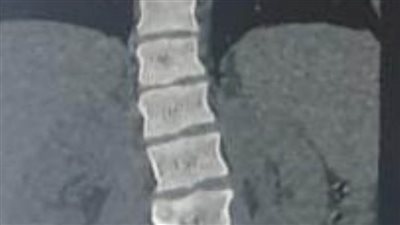 نجاح جراحة إصلاح اعوجاج بالعمود الفقري لأول مرة بالدقهلية 