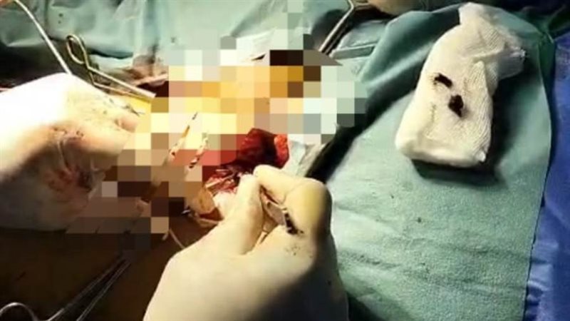 جانبة من اجراء العملية