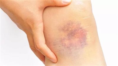 الصحة توضح أعراض مرض الهيموفيليا 