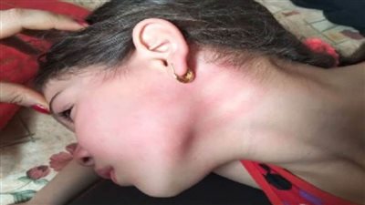 طفلة تتعرض للضرب داخل درس خصوصي في الشرقية.. وصورة موجعة تثير الغضب على السوشيال ميديا