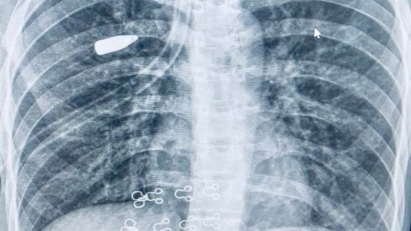 الحالة المصابة