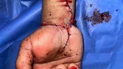  بالصور.. عميد طب طنطا: نجاح إعادة توصيل يد مبتورة بالكامل بعد 3 ساعات من فصلها