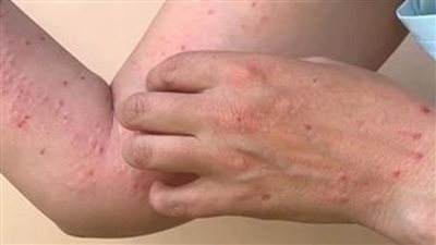 الفلبين: تسجيل 10 حالات إصابة بفيروس جدري القرود بمقاطعة 