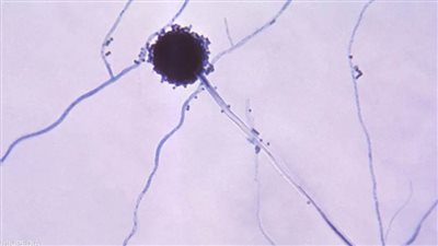 تحذير من انتشارها السريع.. فطريات قاتلة تأكل لحمك من الداخل