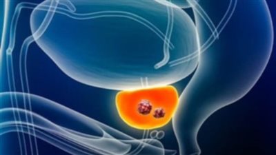 عاجل.. دراسة: الذكاء الاصطناعي يخفض خطر الوفاة بسرطان البروستاتا بنسبة 50٪