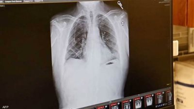   علماء يكشفون سر انتشار سرطان الرئة لدى غير المدخنين