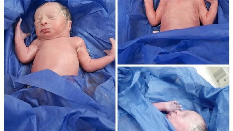 ولادة 3 توأم