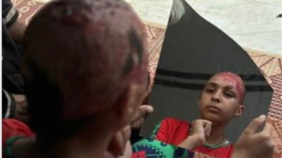 حلا شكري.. طفلة من غزة تحلم بالعلاج في الخارج بعد إصابة خطيرة جراء القصف