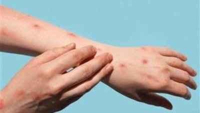 غينيا تسجل 49 إصابة مؤكدة جديدة بمرض جدري القرود