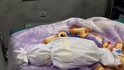 استشهاد 67 طفلا في غزة بسبب سوء التغذية