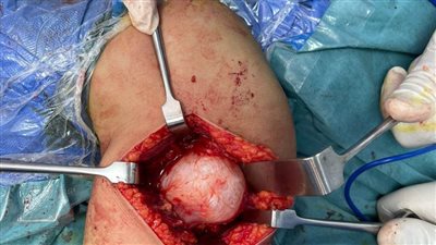 إنقاذ ذراع طفلة من ورم نادر في عملية دقيقة بوحدة جراحات اليد الجراحات الميكروسكوبية بمستشفى سوهاج الجامعي 