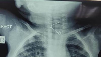 عمره عام.. إنقاذ حياة رضيع ابتلع 