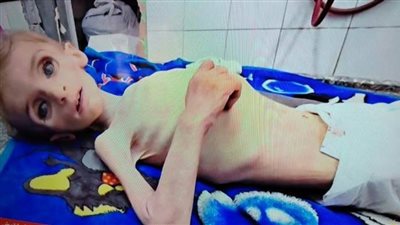 وفاة طفلة فلسطينية بسبب سوء التغذية في دير البلح وسط غزة
