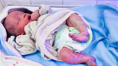 استمرت 60 دقيقة.. نجاح عملية ولادة أول طفل شمعي بالفيوم 