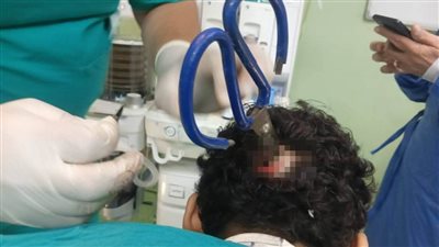 صورة.. استخراج مقص حديدي من جمجمة مريض بالتأمين الصحى ببنها