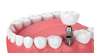 زراعة الأسنان خطوة بخطوة.. كيف تستعيد ابتسامتك بثقة؟