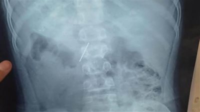 الأطفال التخصصي ينجح في استخراج 