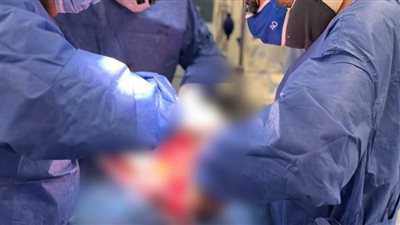 نجاح جراحة معقدة لتصحيح إعوجاج العمود الفقري لطفلة بمستشفيات جامعة قناة السويس