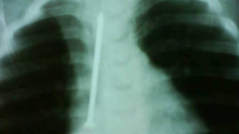 صورة المسمار فى الأشعة