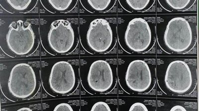 نجاح جراحة ميكروسكوبية دقيقة لاستئصال ورم بالمخ بمستشفى سوهاج الجامعي