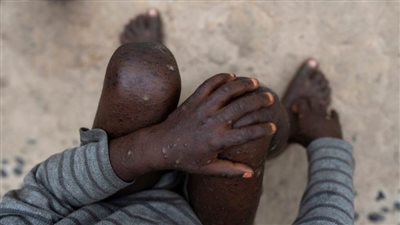 المراكز الإفريقية لمكافحة الأمراض: فيروس ماربورج 