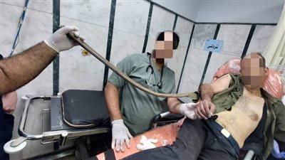 إنقاذ حياة مريض من بتر ذراعه في تأمين صحي بنها