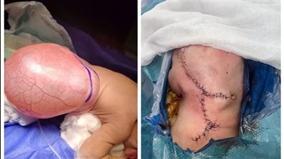 فريق طبي بجامعة أسيوط ينجح  في إجراء جراحة دقيقة لاستئصال 