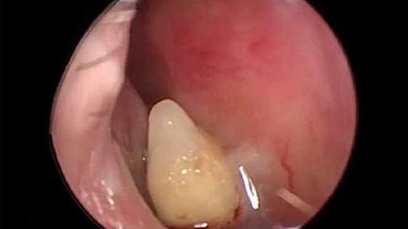 سِنّ ينمو في أنف