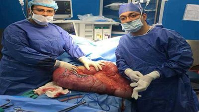 استئصال أضحم قولون لمريضة بمعهد أورام دمنهور