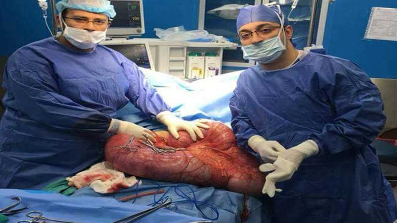 استئصال أضحم قولون