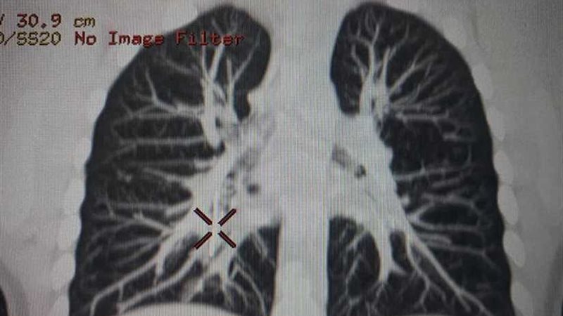 جراحة ناجحة لطفلة