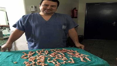 استئصال أكبر ورم ليفي لفتاة 24 عاما فى مصر قبل زواجها