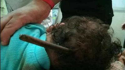 تكريم الفريق الطبي المسؤول عن إنقاذ طفل سيخ الحديد بجامعة طنطا