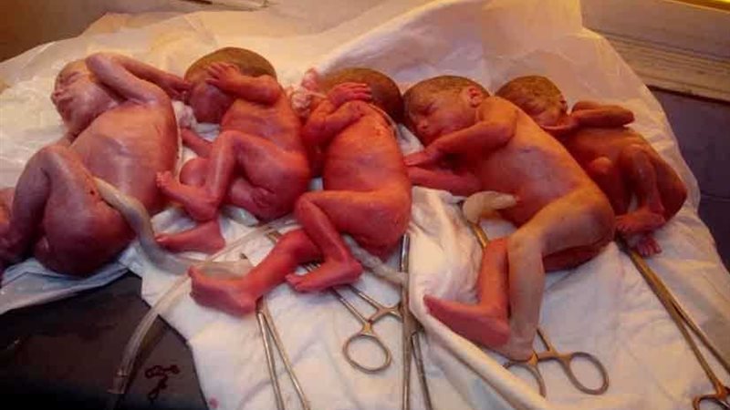 إيمان تنجب 5 توائم