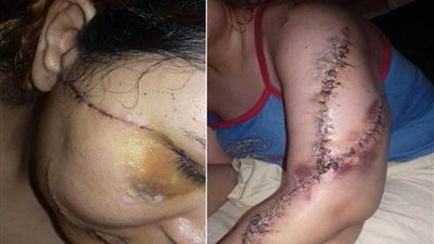 طلبت الخلع فشوهها زوجها بالمطواة.. صور