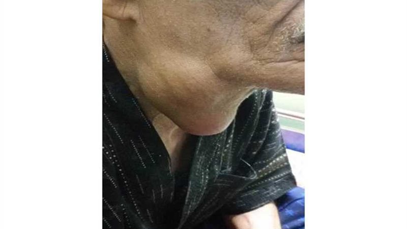 استئصال ورم من رقبة