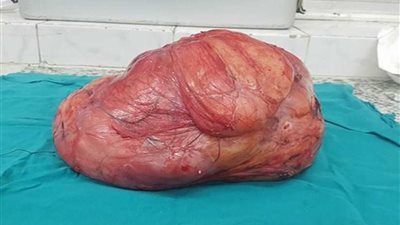 فريق طبي ينجح فى استئصال ورم يزن 30 كيلو