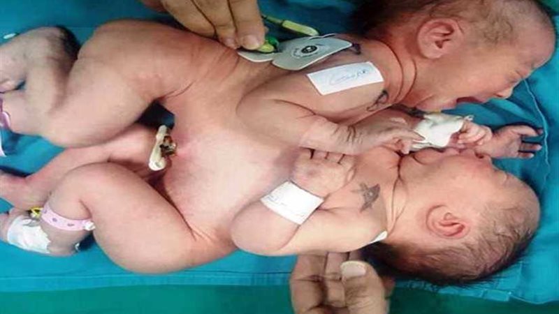 جراحة نادرة لفصل