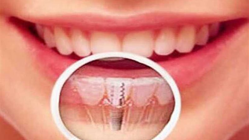 هكذا يمكن زراعة الأسنان