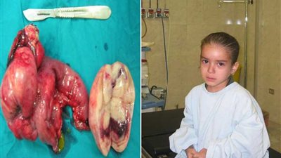 للمرة الأولى.. إزالة ورم خبيث مزدوج بالغدد والمبيض لطفلة بالإسكندرية