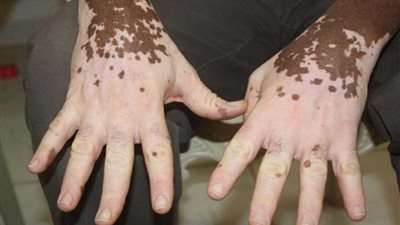 البهاق.. ماذا تعرف عنه وما علاجه